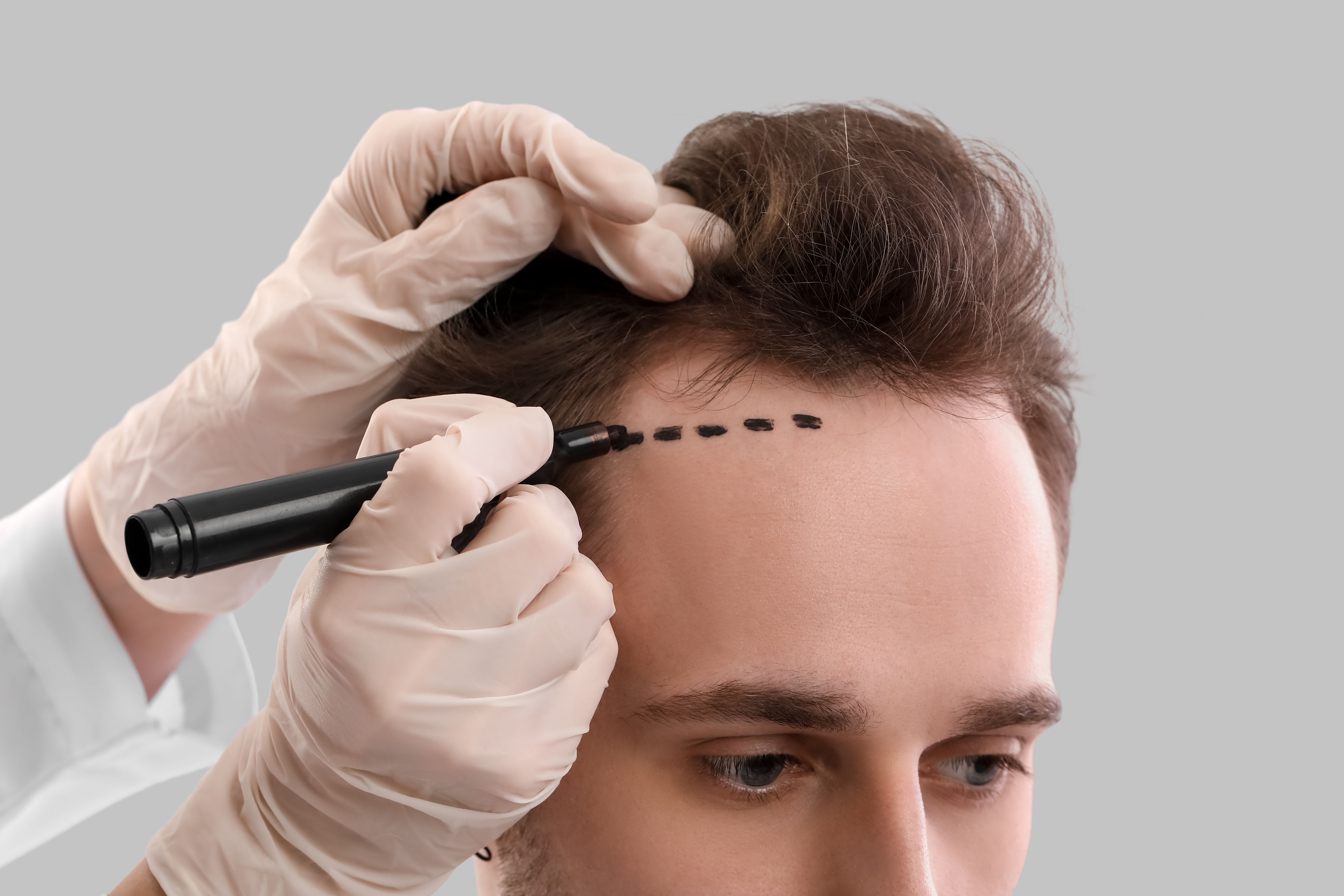 foreheadreduction: plasticsurgery: plastic surgeon: reviews.jpg